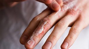 How to treat fungal infection