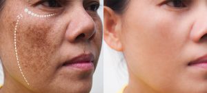 What-is-Melasma