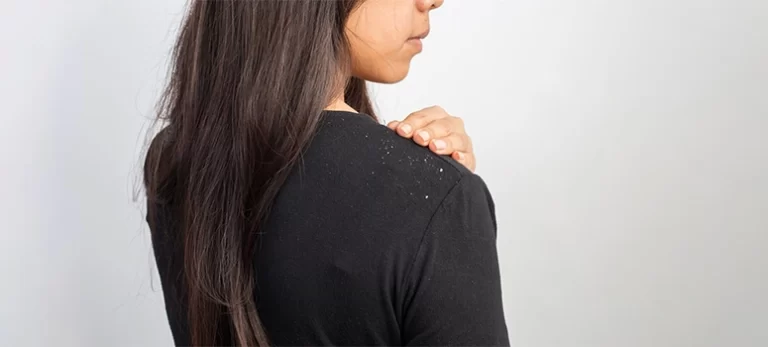 A-General-Guide-on-How-to-Reduce-Dandruff-and-Hairfall