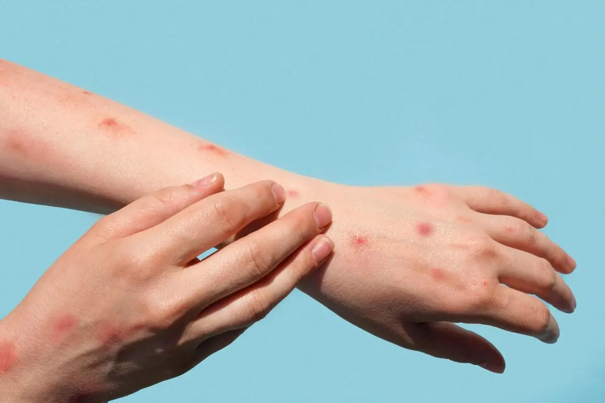 Monkeypox-Disease