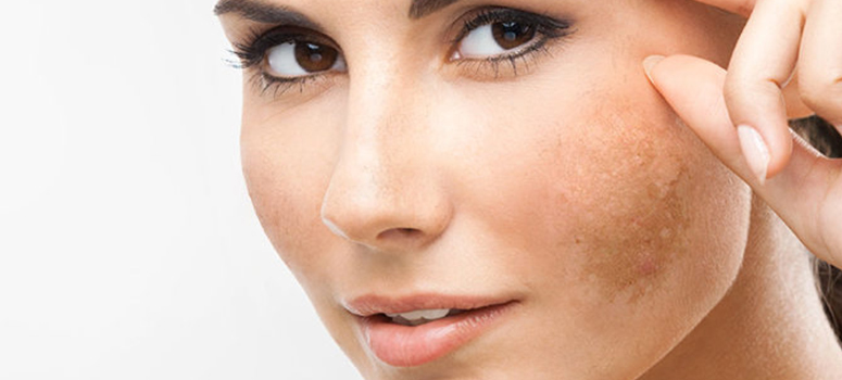 Different Types Of Skin Pigmentation And Its Treatment
