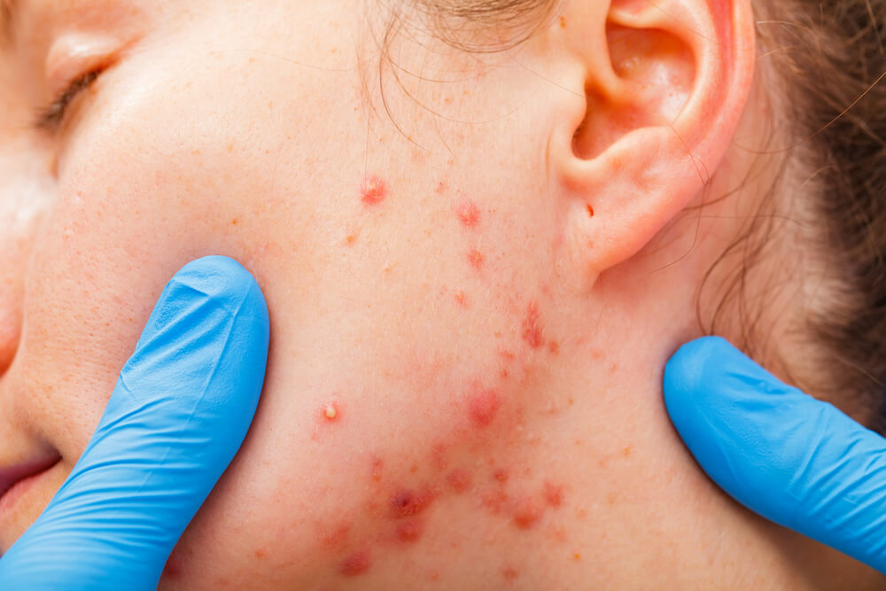 Treatment Of Adult Acne With History Of Reactions to Topical Medication