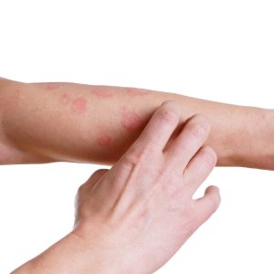 Successful treatment of severe atopic dermatitis with systemic corticosteroids, montelukast sodium tablets
