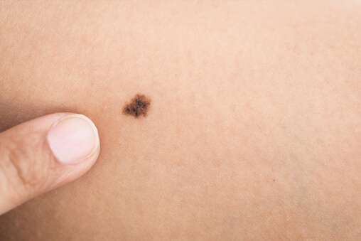 symptoms-melanoma