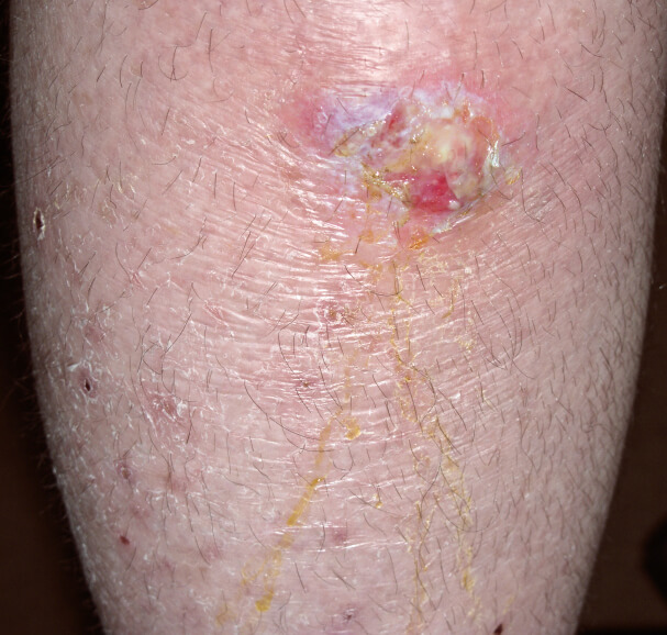 Cellulitis