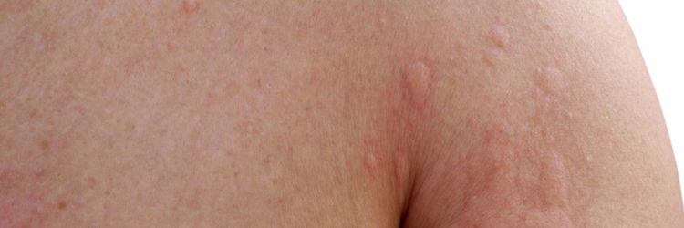 Learn Everything About Hives, Their Causes And How To Prevent Them