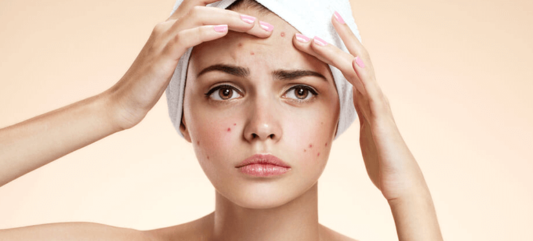 All you need to know about acne