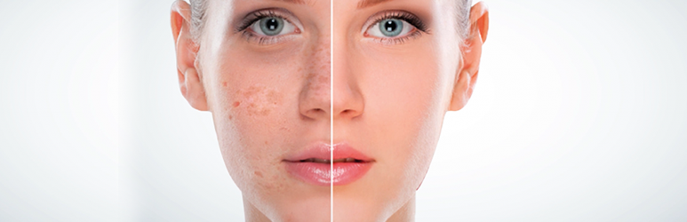 Types Of Hyperpigmentation: How To Treat Them!