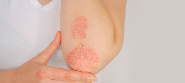 7 Proven Tips to Reduce Psoriasis Flare-Ups