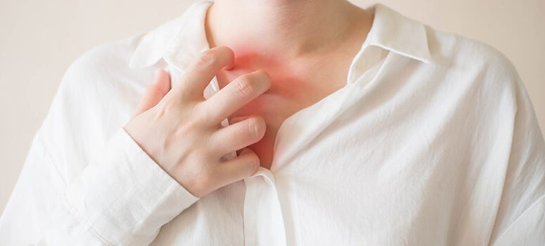 Heat Rash and its treatment