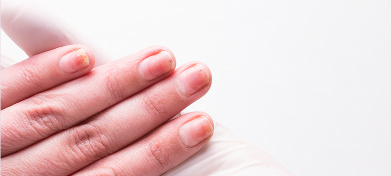 Nail Psoriasis: Psoriasis in Fingernails and Toenails