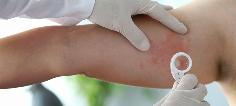 Everything You Need To Know About Dermatitis
