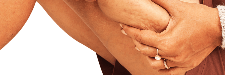Know About The Causes, Symptoms And Treatments of Cellulite On Body