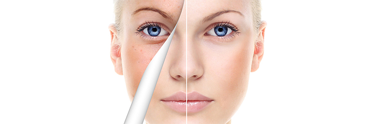 Understand the difference between AHA and BHA Chemical Peels