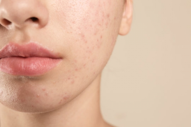 What are Comedones/Comedonal Acne