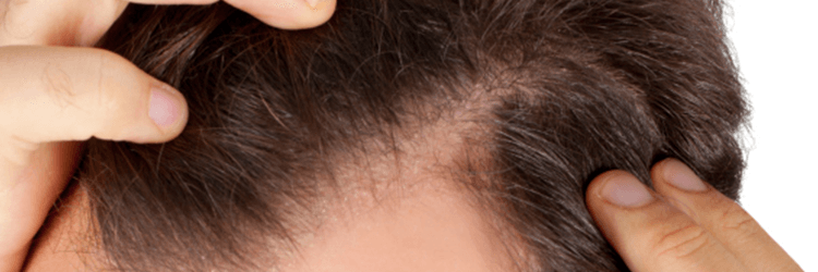 DEAL-WITH-HAIR-LOSS-THE-RIGHT-WAY