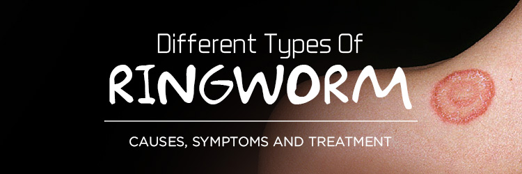 Different_Types_Of_Ringworm_-_Causes_Symptoms_And_Treatment