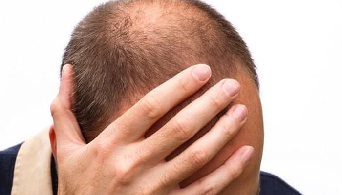 Male-pattern hair loss