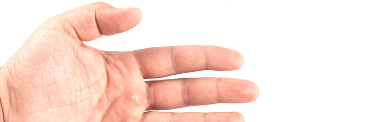 What is Calluses and how to deal with them. Find everything about Calluses here