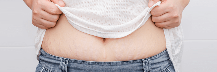 HOW-TO-GET-RID-OF-STRETCH-MARKS
