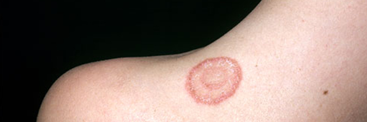 How to Get Rid of Ringworm
