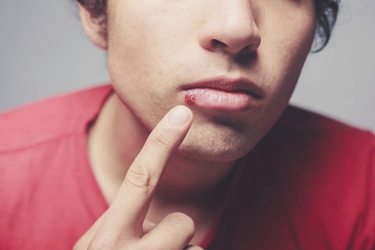 Herpes Simplex Skin Disease