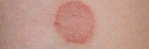 Ringworm: Common Myths & Facts