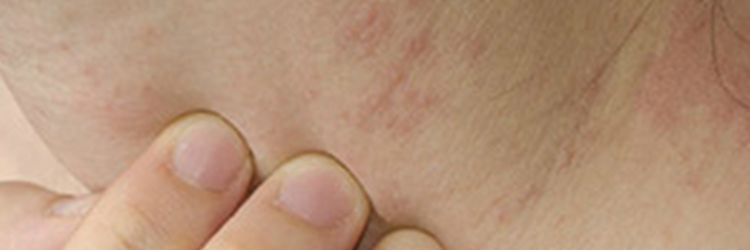 Causes and Treatment Options for Itchy Skin Problems Also Known as Pruritus