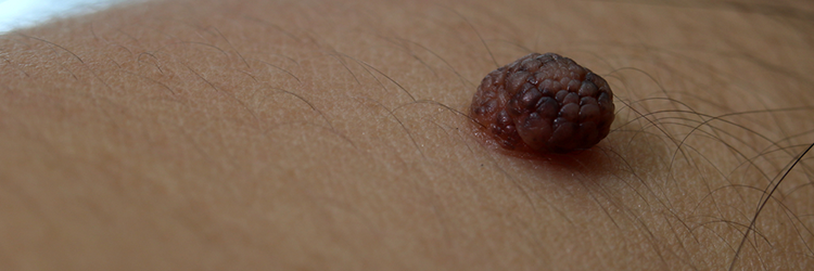 Moles can be Harmless and Harmful. Learn Everything About Moles Here