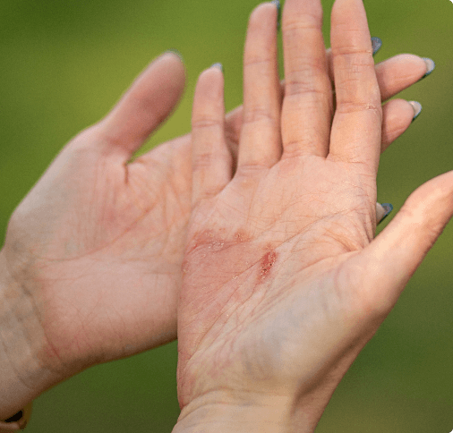 Skin-to-skin contact with what can flare up contact dermatitis?