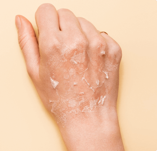 What does dermatitis look like?