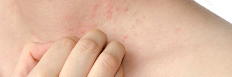 What causes Psoriasis? Find out symptoms and the right cure for Psoriasis