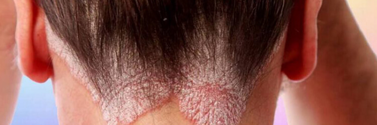 6 Things You Need To Know About Psoriasis