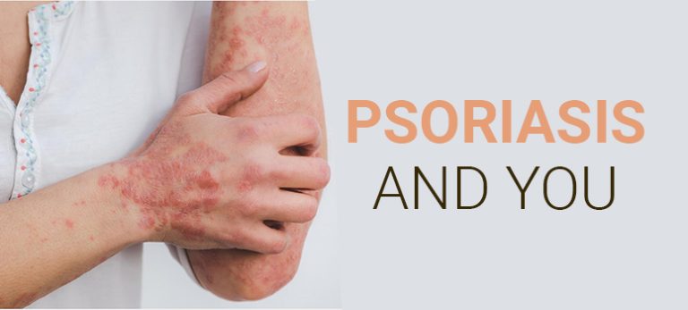 Psoriasis and you: Know everything about Psoriasis from Dr Sachin Varma