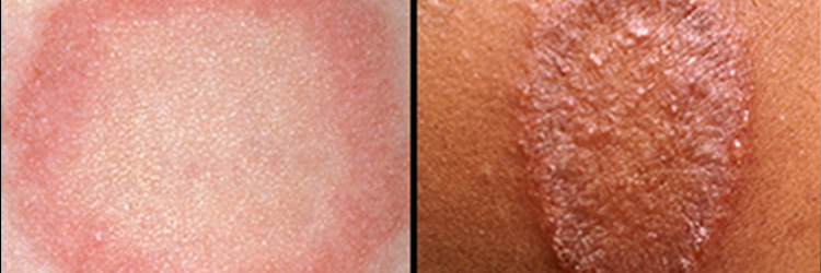 Ringworm_Vs._Psoriasis__Diagnosing_the_Difference