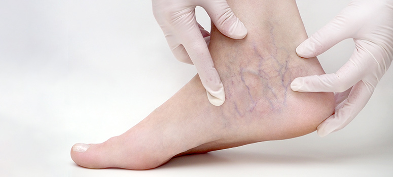 Spider Veins: Everything about Symptoms and Treatments