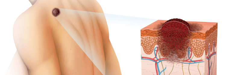 SKIN-CANCER-THE-SCIENCE-AND-THE-CURE