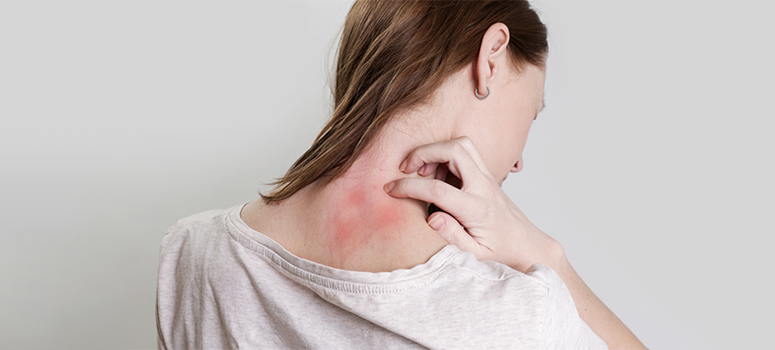 Miliaria Rubra- How to Get Rid of Heat Rash This Summer?