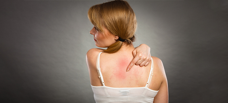 Sun Allergy – Symptoms, Causes And Prevention Aka – Solar Urticaria