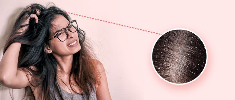 How to Reduce Dandruff and Hairfall