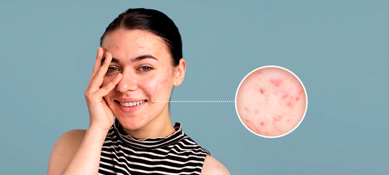 Myths and Facts About Acne