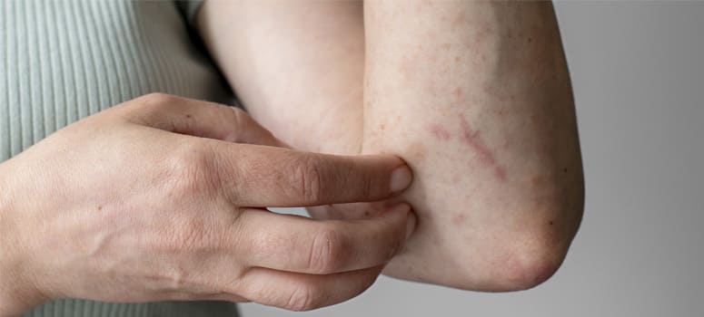 Hand Eczema (Dyshidrotic Eczema) - Types, Causes, Symptoms & Treatment