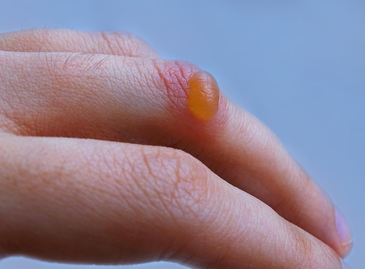 Blisters: Meaning, Types, Causes, Treatment