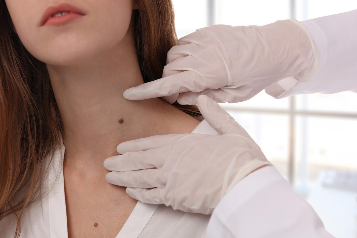What are Skin Tags (Acrochordon) and how to treat them?