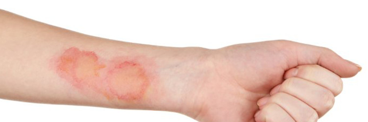 Bacterial Skin Infections 101