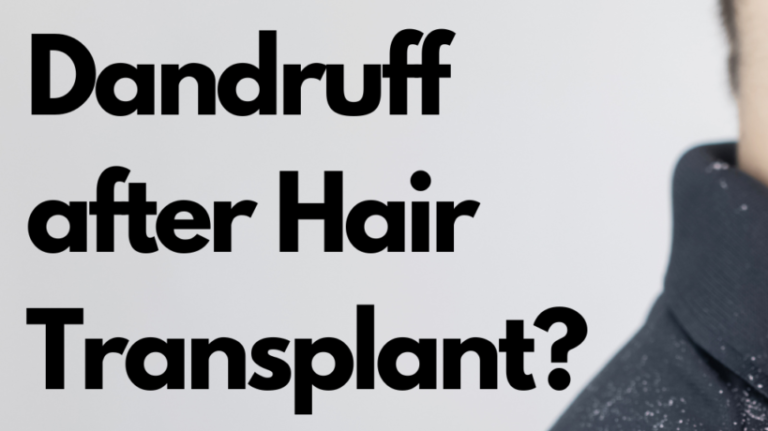 Types-of-Hair-Loss