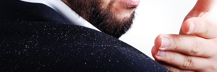 Learn The Causes And Effects Of Dandruff And Break The Myths Involved