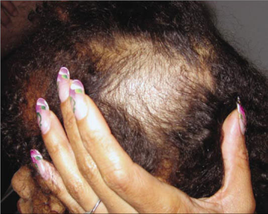 non-scarring-alopecia