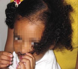 Case: A 4 year old child’s case with non-scarring alopecia