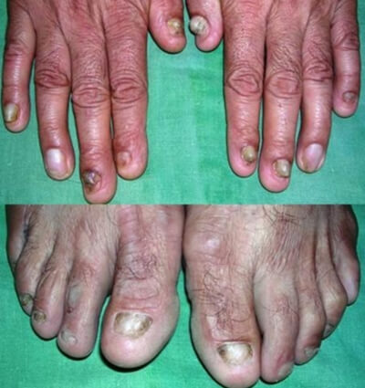 Case: Successful cure of Chronic itching & lesions in a 40 Years old man